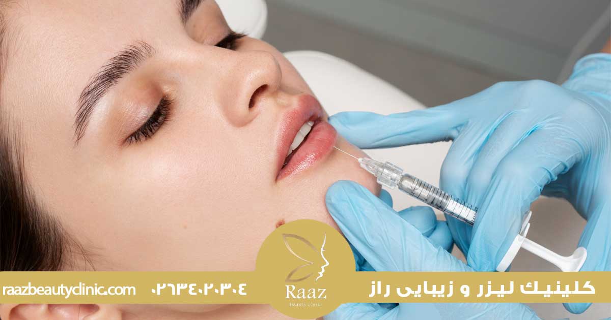 زیبایی لب با تزریق ژل در کرج در کلینیک زیبایی راز با جدیدترین روش ها 3 تزریق ژل لب در کرج