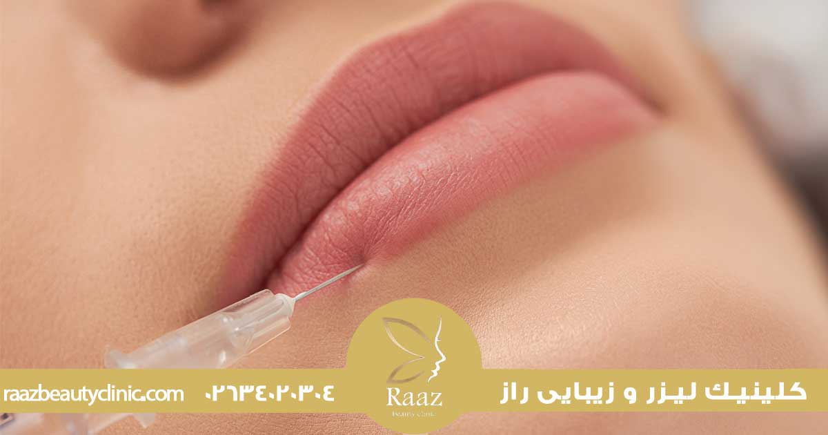 زیبایی لب با تزریق ژل در کرج در کلینیک زیبایی راز با جدیدترین روش ها 4 تزریق ژل کرج