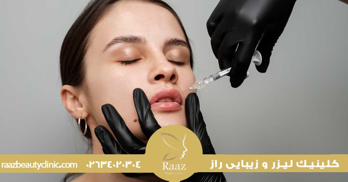 زیبایی لب با تزریق ژل در کرج در کلینیک زیبایی راز با جدیدترین روش ها 6 لیفت لب در کرج