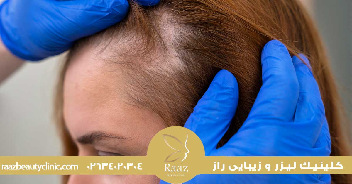 PRP مو در کرج، راهنمای کامل درمان ریزش مو، مزایا، هزینه ها و مراکز معتبر 2 عملکرد prp مو در کرج