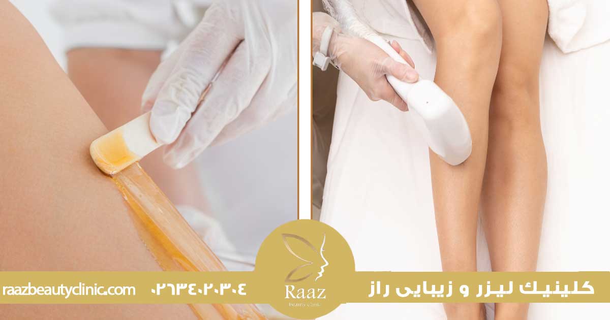لیزر بهتره یا اپیلاسیون؟ مقایسه واقعی که همه دنبالشن 5 لیزر خوبه یا اپیلاسیون