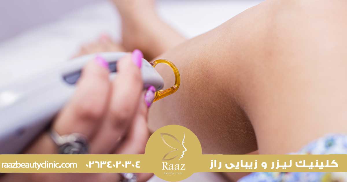ضخیم شدن مو بعد از لیزر، بررسی علمی عوامل و نکات مراقبتی برای بهترین نتیجه 3 چرا بعد لیزر موها بیشتر میشود