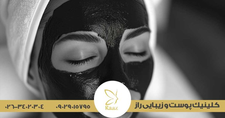 لیزر هالیوودی در کرج ( پلینگ کربن) 48 لیزر هالیوودی در کرج ( پلینگ کربن)