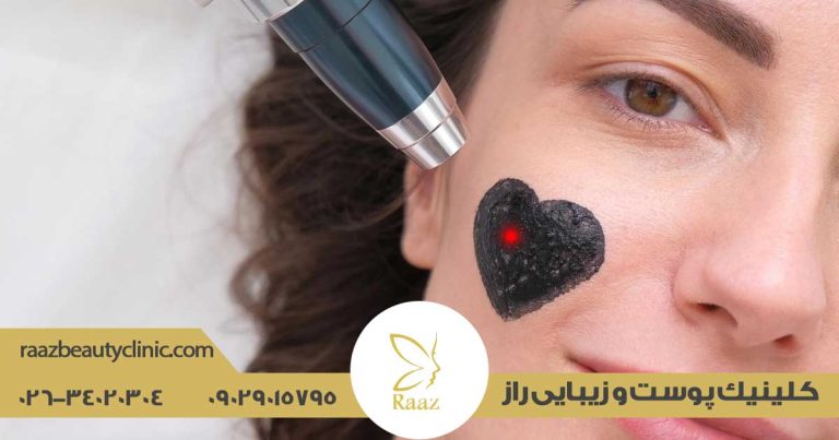 لیزر کربن در کرج 31 لیزر کربن در کرج