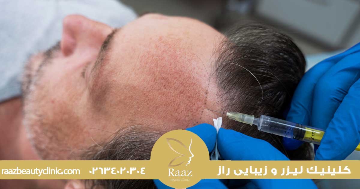 prp مو در کرج