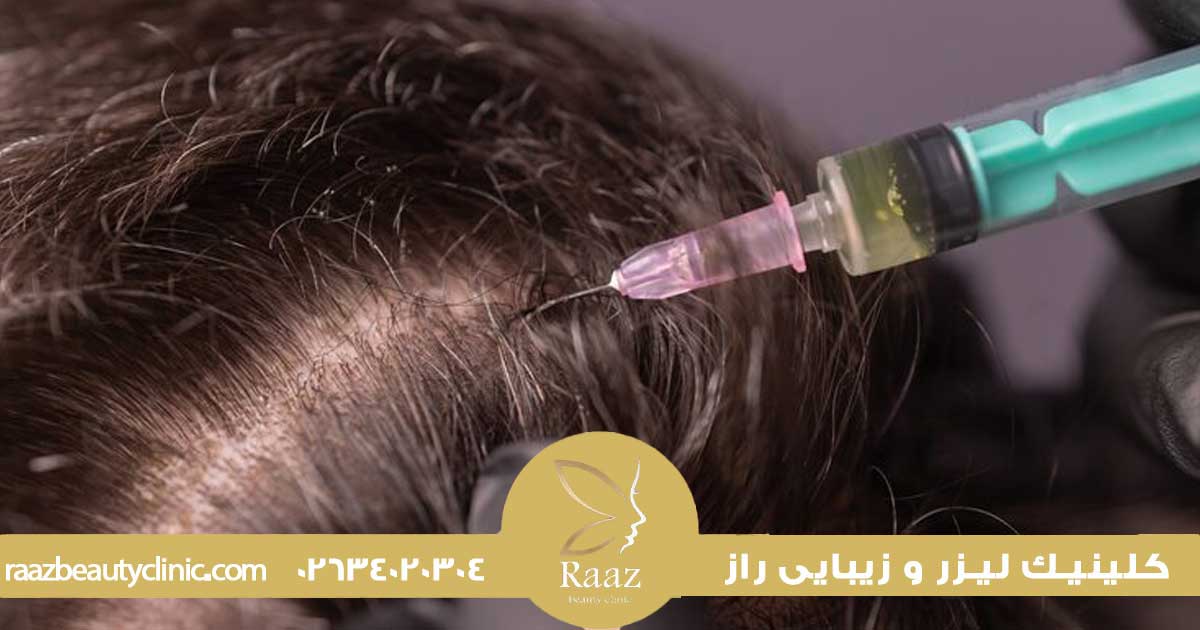 مزوتراپی در کرج