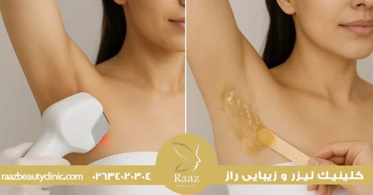 لیزر بهتره یا اپیلاسیون؟ مقایسه واقعی که همه دنبالشن 26 لیزر بهتره یا اپیلاسیون