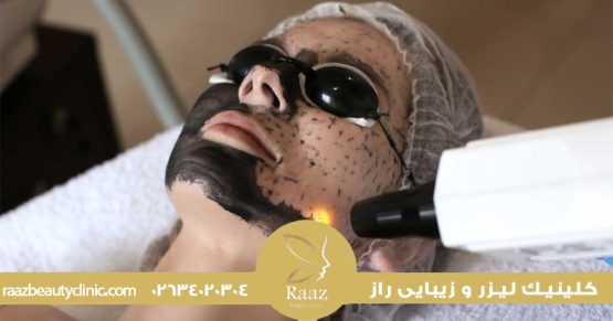 مزایا و معایب استفاده از کربن لیزر برای جوانسازی پوست صورت 1 پاکسازی صورت با لیزر