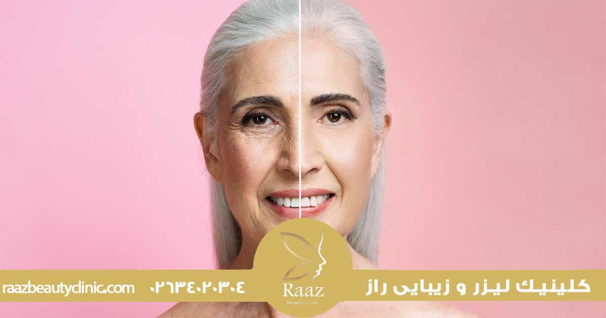 خدمات 46 بهترین سن برای بوتاکس
